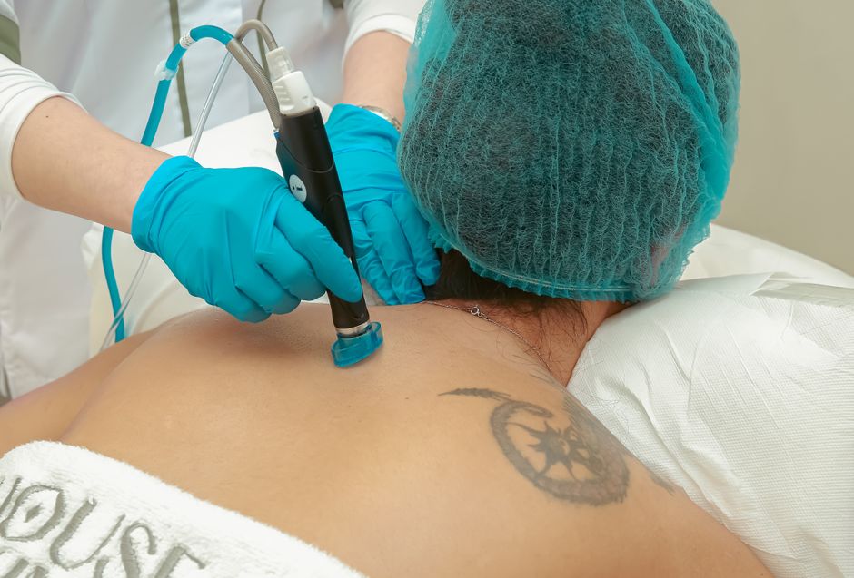 Tattoo Removal (per session)